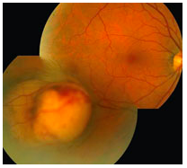 Extraocular Cancer Ocular tumors - UCSF Department of Radiation Oncology