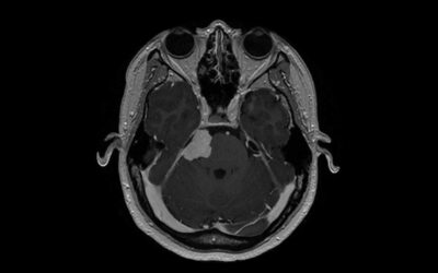 Meningiomas are associated with some birth control